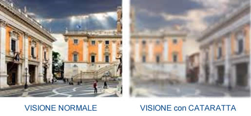 Cataratta - differente visione tra occhio sano ed occhio affetto da Cataratta